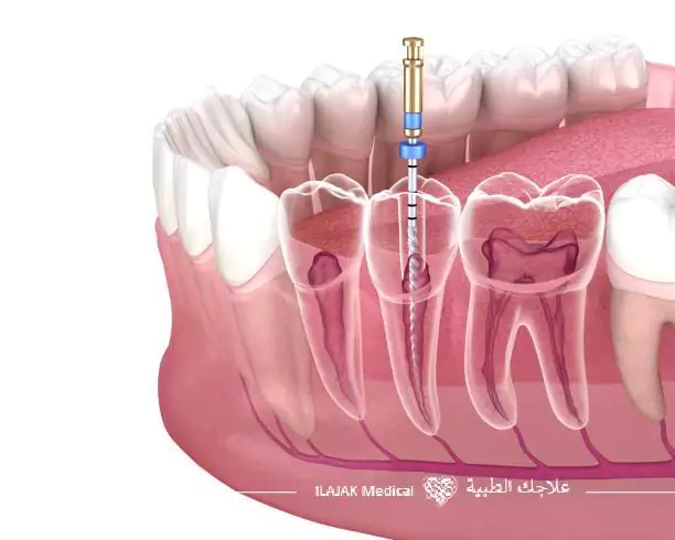  علاج الجذور 